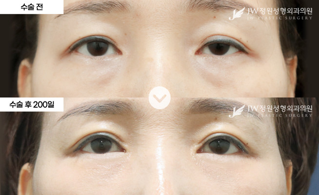 중년여성(40~60대) 하안검 중안면거상 + 눈매교정