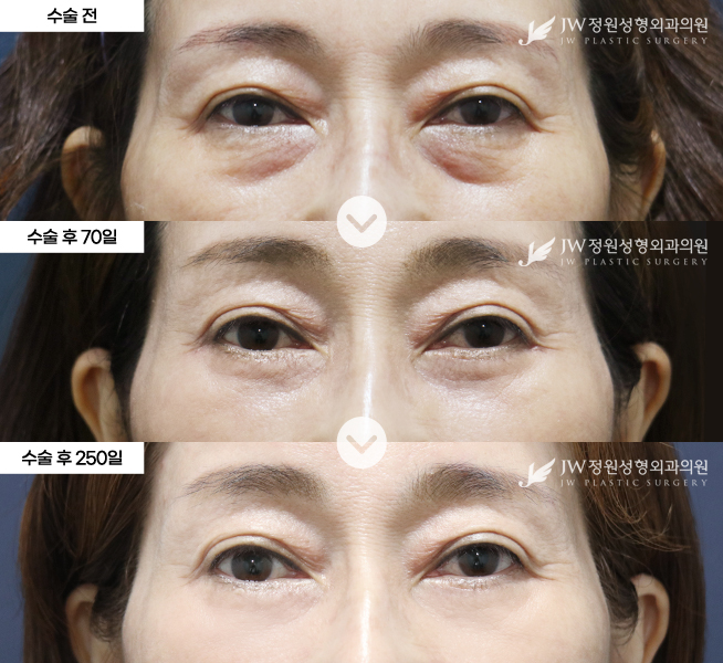 노년여성(50~70대) 하안검 중안면거상